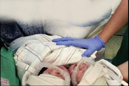 İNANILMAZ-Ukraynada ikibaşlı qız doğulub