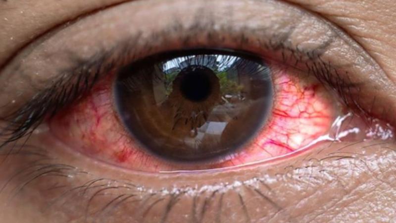 Yeni epidemiya: "Qırmızı göz" xəstəliyi, 7500 nəfər yoluxub