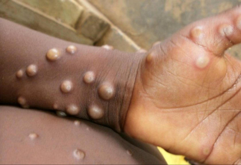 Rusiyada meymunçiçəyi virusu aşkar edildi