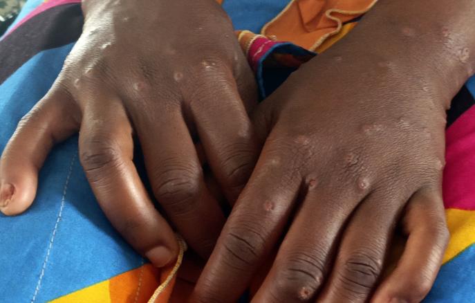 Rusiyada meymunçiçəyinə yoluxma hallarına rast gəlinib